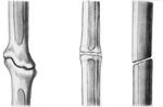 limb reconstruction ricostruzione arti pseudoartrosi