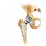 protesi totale anca posizionata artrosi 