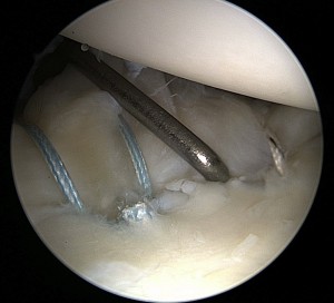 ortopedico artroscopia spalla