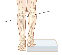 DISMETRIA ARTI Leg length discrepancy