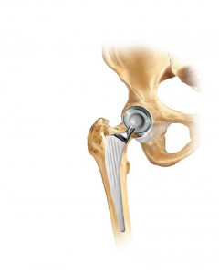 protesi totale anca posizionata artrosi